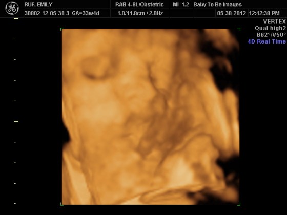 3D-Sonogram-1